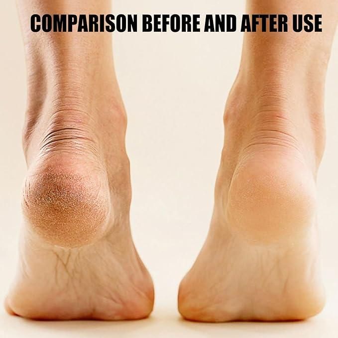 Electronic Pedicure Callus Remover – Rechargeable Foot Care Tool for Smooth, Soft Heels (Portable & Gentle)